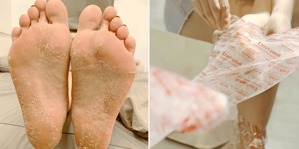 Original Exfoliation Foot Peel