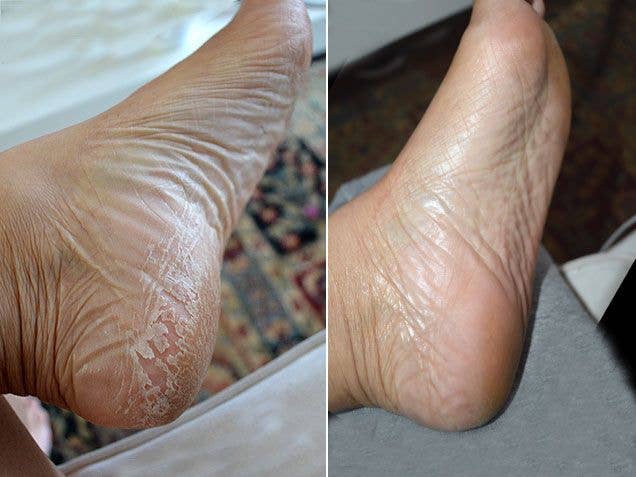 Original Exfoliation Foot Peel