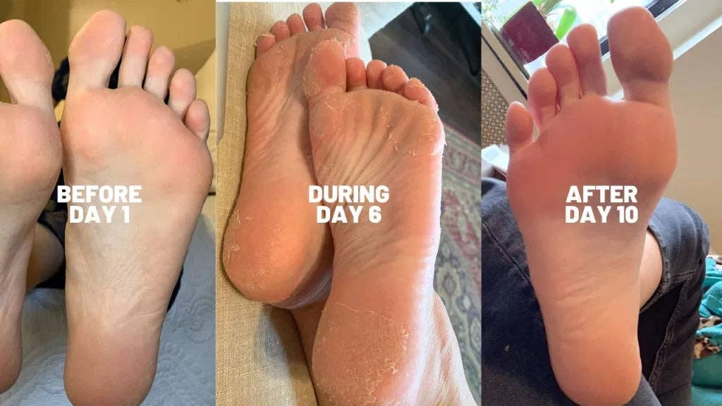 Original Exfoliation Foot Peel
